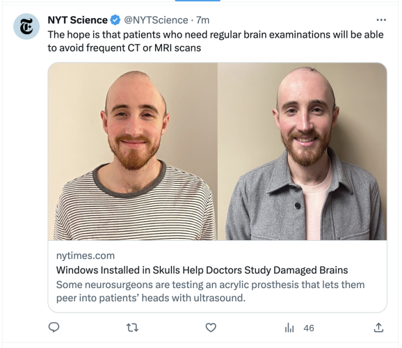 NY Times headline: "Windows Installed in Skulls Help Doctors Study Damaged Brains"
