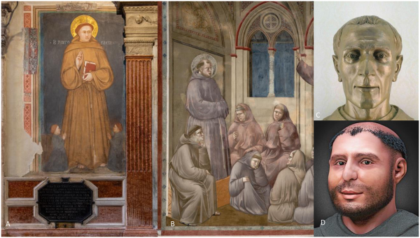 A) St Anthony giving his blessing, Giotto School. This portrait is considered to reflect the true effigy of the Saint. Padova, Basilica del Santo (1238–1310), Giovanni Pinton/ Archivio Fotografico Messaggero di Sant’Antonio, 2020. (B) Giotto, St Francis appears in the Chapter of Arles, ca. 1295–1299. Assisi, Chiesa Superiore of Basilica di San Francesco. In the detail, St Anthony is illustrated suffering, with a bloated abdomen. (C) Bust of St Anthony, detail. Bronze sculpture by Roberto Cremesini, 1995. This is a scientific reconstruction of the ’real’ face of the Saint, based on the skull found after the recognition of his body in 1981. In the reproduction of this bust, the artist relied on the advice of three scholars: C. Corrain (anthropologist), V. Meneghelli (anatomist) and V. Terribile Wiel Marin (anatomopathologist). Photo by Giorgio Deganello/ Archivio Fotografico Messaggero di Sant’Antonio, 1995. (D) The 3D Forensic Facial Reconstruction of St Anthony of Padua. Cicero Moraes—Opera propria, CC BY 3.0, https://commons.wikimedia.org/w/index.php?curid=33660858.

https://doi.org/10.1371/journal.pone.0260505.g001